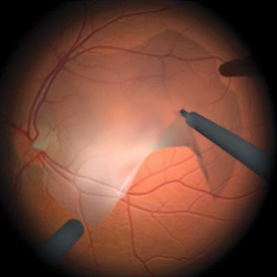 Is there an alternative treatment for eye membrane surgery?